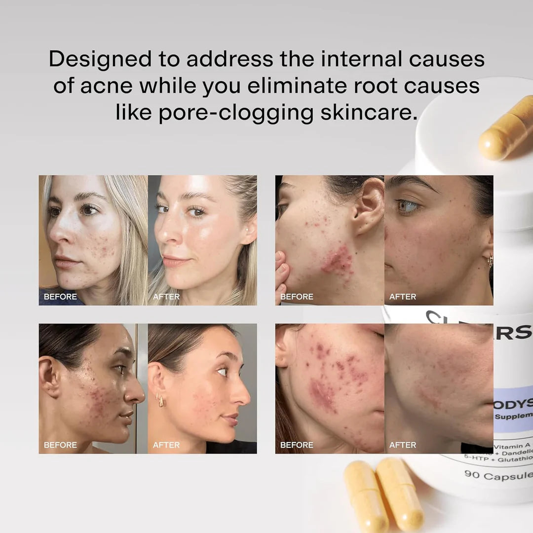 NUMI® Hormonal Acne Supplement